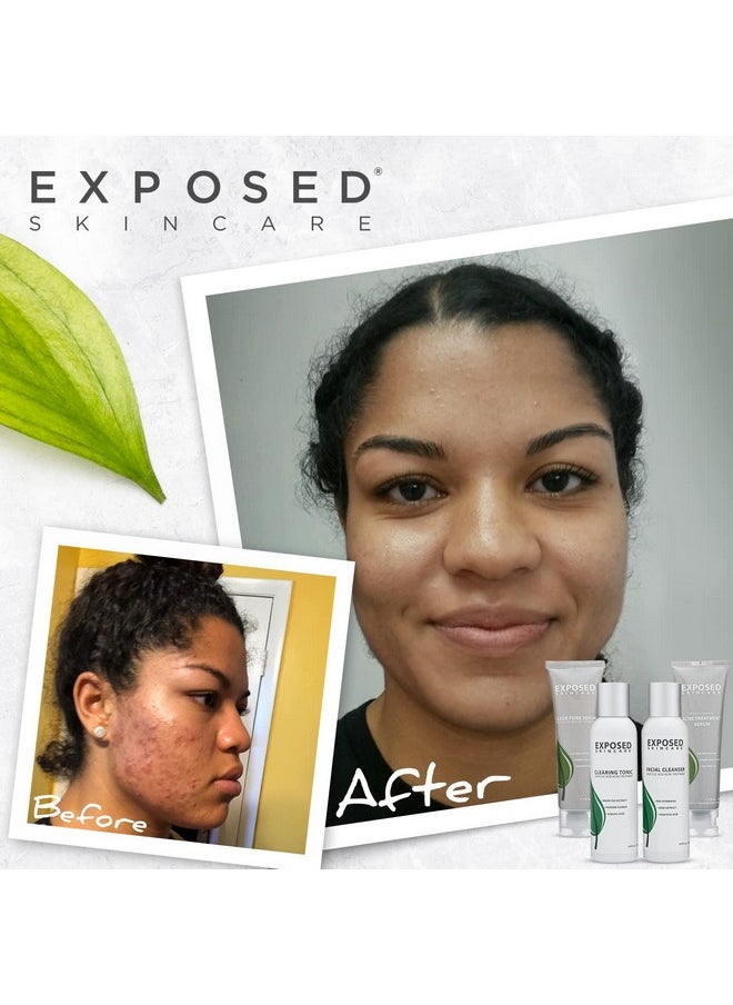 Exposed Skin Care - Xposed Skin Care Basic Acne Treatment Kit Includes Salicylic Acid Face Wash Clearing Tonic Treatment Serum With Benzoyl Peroxide Clear Pore Serum Natural Acne Solution For All Skin Types - Image 1
