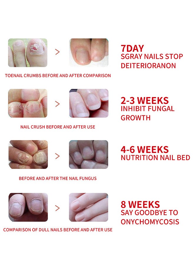 SOUTH MOON - Rapid Nail Care Liquid - Fungal Nail Treatment For Toe Nail And Fingernails For Thick Broken Discolored Nails - Renews Damaged Cracked Ingrown Toenail - Image 1