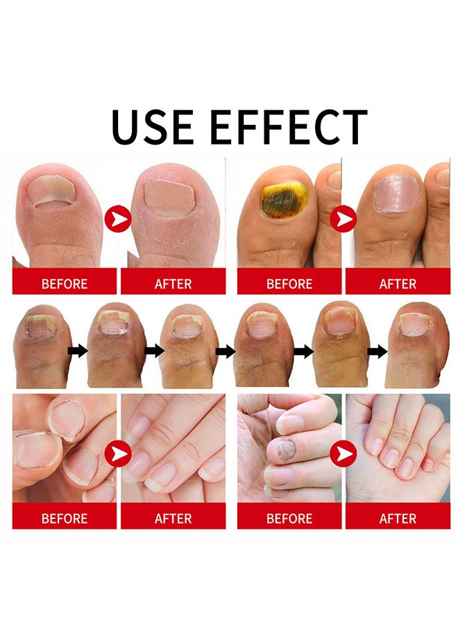 SOUTH MOON - Rapid Nail Care Liquid - Fungal Nail Treatment For Toe Nail And Fingernails For Thick Broken Discolored Nails - Renews Damaged Cracked Ingrown Toenail - Image 1