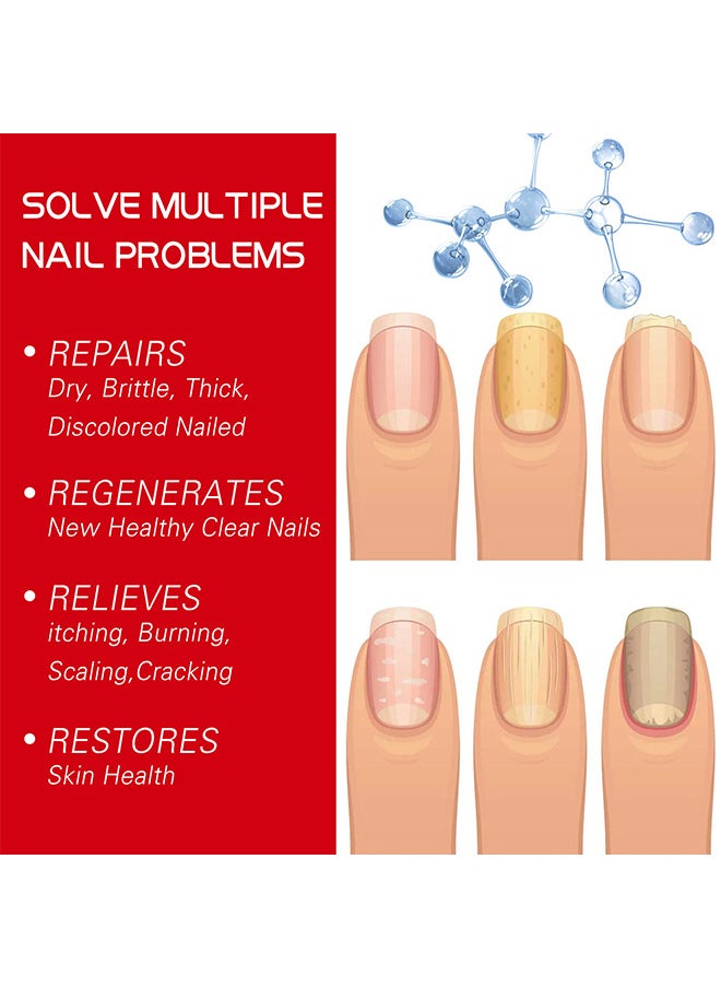 SOUTH MOON - Rapid Nail Care Liquid - Fungal Nail Treatment For Toe Nail And Fingernails For Thick Broken Discolored Nails - Renews Damaged Cracked Ingrown Toenail - Image 1