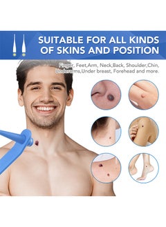 Sefudun 2 In 1 Skin Tag Removal Tool Kit Painless Easy-Using Device For Small To Large Sized Skin Tag On Face Neck And Body， Double Head Wart Removal Tool Skin Tag Removal Blue  - Image 5