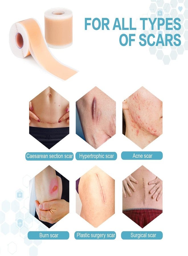 SAMTA ENTERPRISE Samta Silicone Scar Sheets (1.6”x60”Roll-1.5M), Silicone Scar Tape, Reusable Scar Removal Sheets for C-Section, Surgery, Burn, Keloid, Acne - Image 5