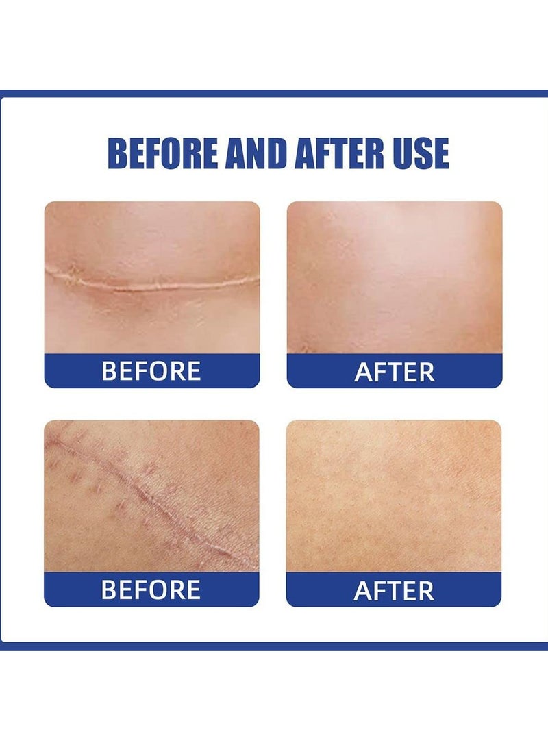 Silicone Scar Sheets, Reusable Washable Silicone Scar Tape, Surgery Scars Removal Treatment, Medical Grade Silicone Scar Sheets for Breast, 4 Areola Soft Strips  4 Anchor Sheets Care Patch - Image 4