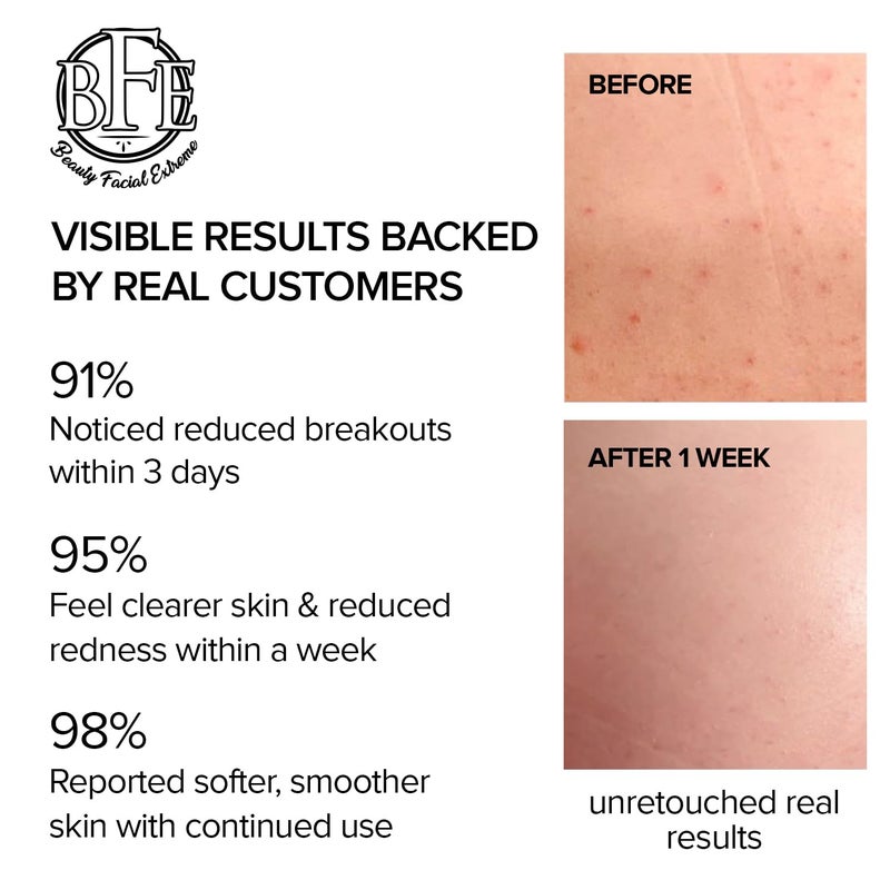 بيوتي فيشال إكستريم علاج مضاد لحب الشباب في منطقة الفخذين والأرداف يزيل حب الشباب والبثور والشعر الذي ينمو تحت الجلد في منطقة الفخذين والأرداف. يمنع الانتشار في المستقبل. - Image 5