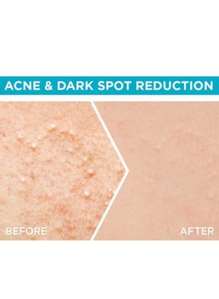 Skinactive Fast Clear Booster Face Serum For Acne Prone Skin With Salicylic Acid, 15ml - view 4