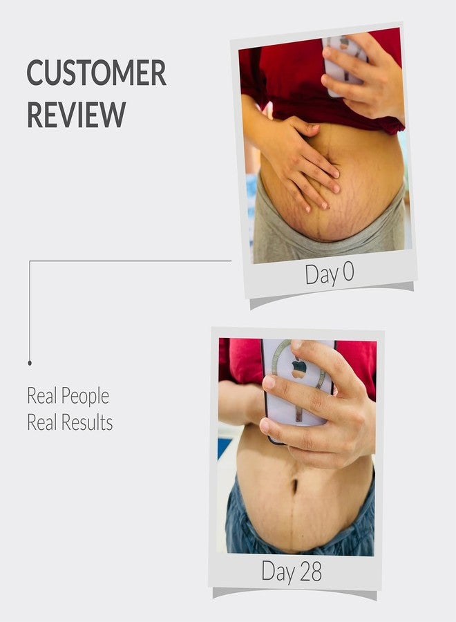 AreoVeda Stretch Marks Removal Cream (50g) | Targets Stubborn Old & New Stretch Marks | Powered With Striover & CryoCoffee | Non-Sticky, Fast Absorbing | Pregnancy & Breastfeeding Safe - Image 3