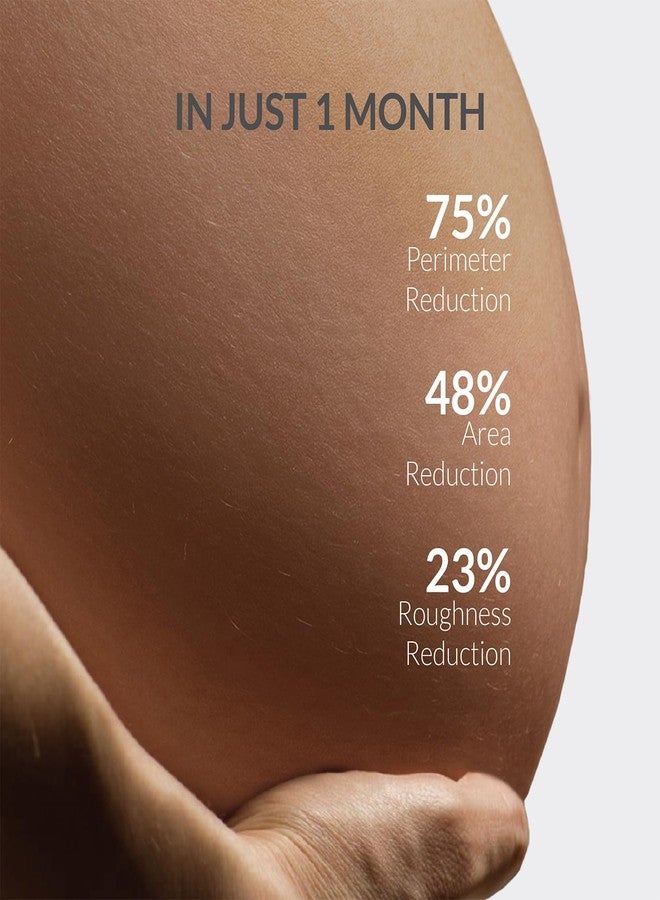 AreoVeda Stretch Marks Removal Cream (50g) | Targets Stubborn Old & New Stretch Marks | Powered With Striover & CryoCoffee | Non-Sticky, Fast Absorbing | Pregnancy & Breastfeeding Safe - Image 2