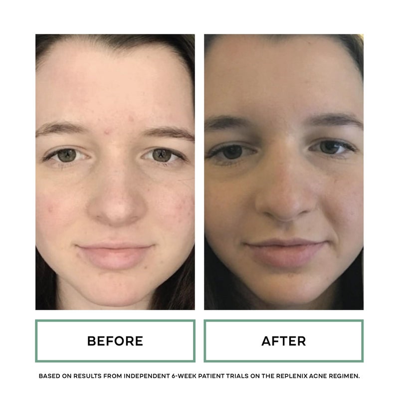 Replenix Gly-Sal Deep Pore Acne Face Wash, 6.7 Fl Oz, Non-Oily Medical-Grade 5% Glycolic & 2% Salicylic Acid Facial Cleanser for Acne-Prone Skin, Gently Unclogs & Refines Pores, Non-Drying - Image 4