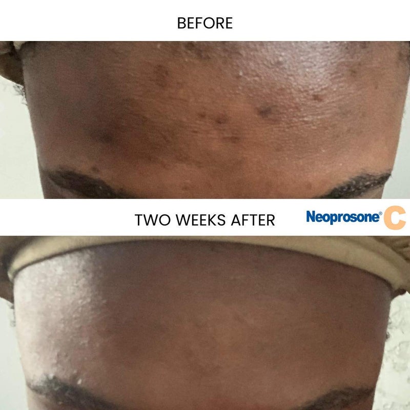 Neoprosone نيوبروسون، سيروم فيتامين سي للوجه | 1 أونصة سائلة / 30 مل | سيروم تفتيح للهالات السوداء، التجاعيد | مع ألفا أربوتين وزيت الخروع - Image 3