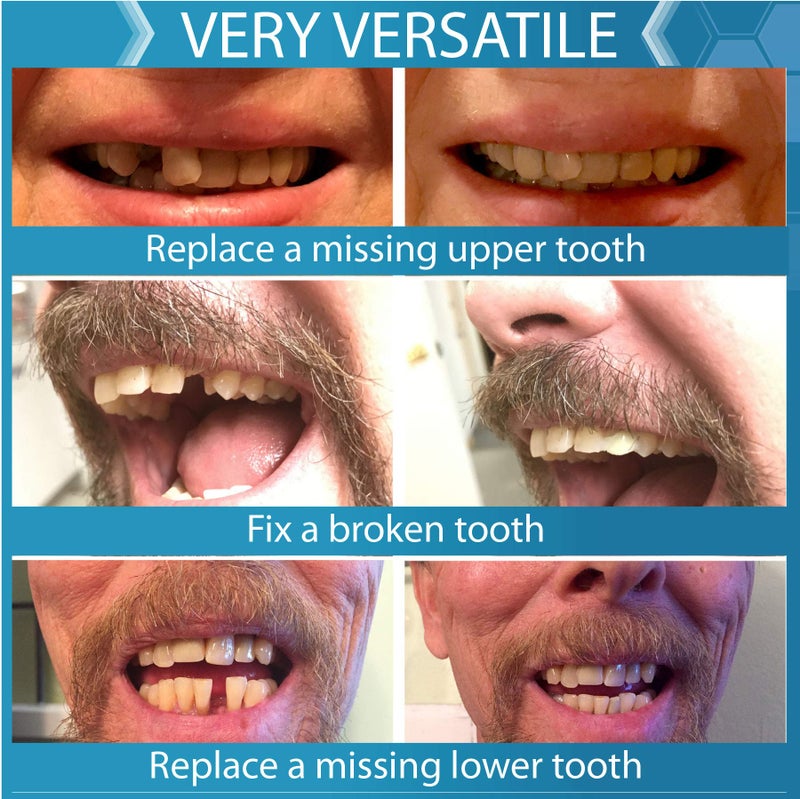Instant Smile Complete Your Smile Temporary Tooth Replacement Kit - Replace a Missing Tooth in Minutes - Patented - Image 5