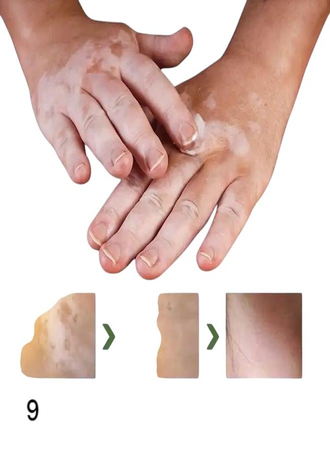 Zero Pathy Vitiligo Skin Tone Serum 35ml - Natural Vitiligo Cream with Turmeric, Aloe Vera & Ginseng, Designed to Restore Pigmentation, Treat White Patches, Moisturize, and Improve Overall Tone & Texture Body serum - Image 4