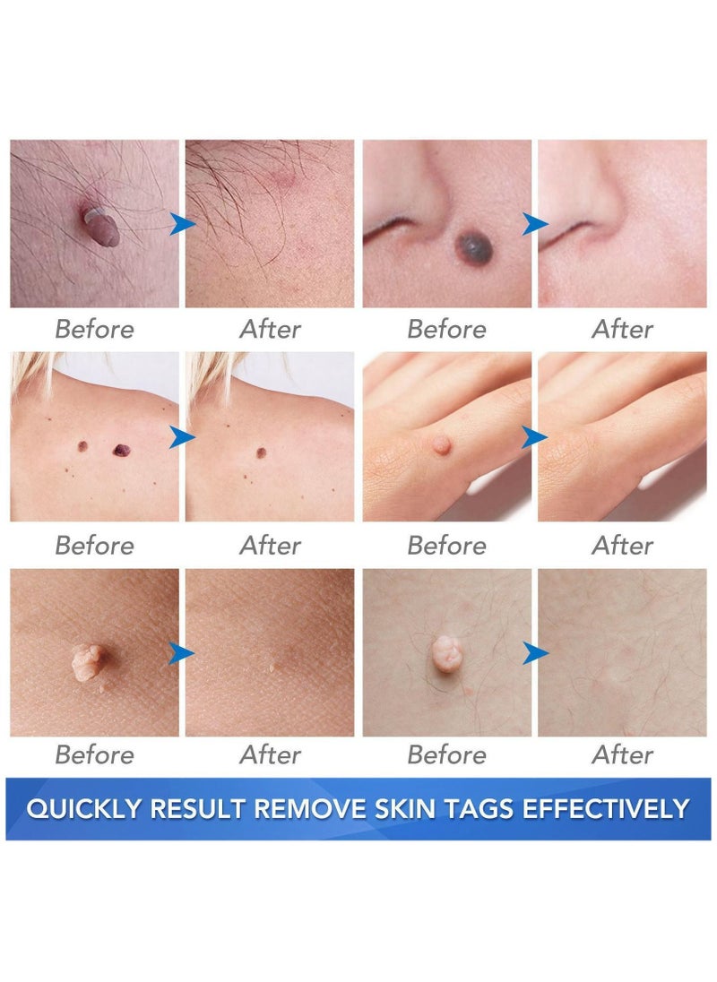 Elaimei Skin Tag Remover Mole Remover Effectively Removes Skin Tag And Mole Quick Results & Effective All Natural Extract Suitable for All Skin Types Easy Use at Home 30ml  - Image 3
