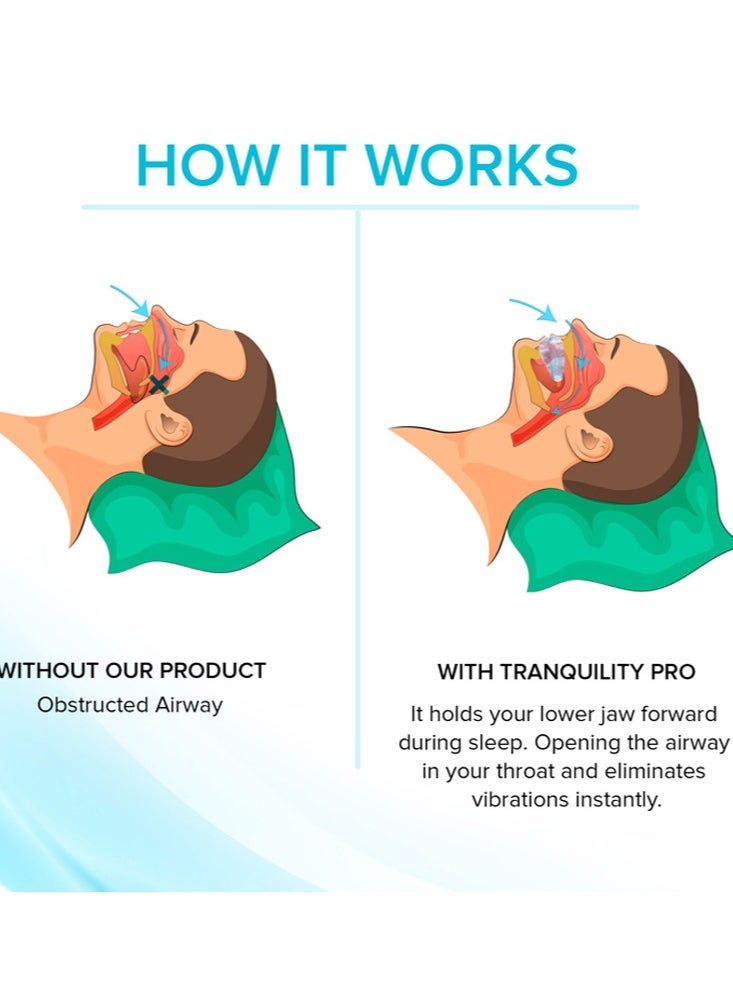 Joshberg - Anti Snoring Bruxism Mouth Guard Improve Sleeping Apnea Snoring Device To Stop Snoring - Image 1