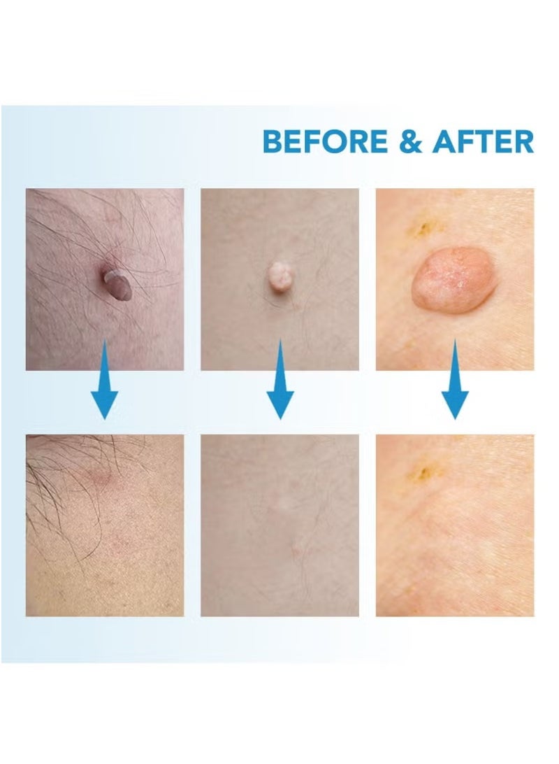 Sefudun Wart Removal Tool Skin Tag Removal Double Head - Image 4