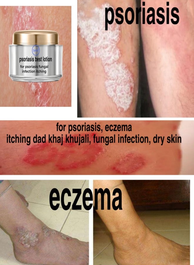 samta Psoriasis best lotion - Image 2