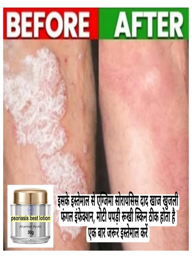 samta Psoriasis best lotion - Image 3