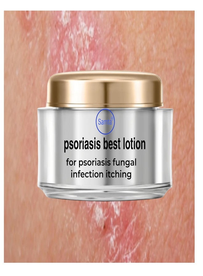 samta Psoriasis best lotion - Image 1