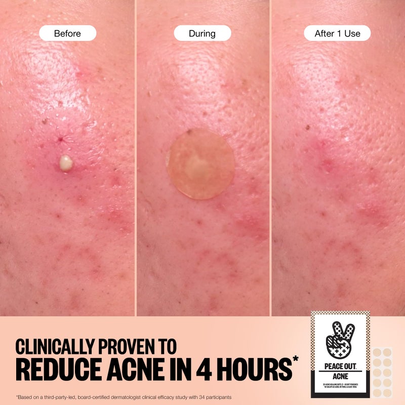 PEACE OUT Acne Healing Dots Hydrocolloid Pimple Patches, Acne Spot Treatment with Salicylic Acid, Retinol, and Aloe Vera for Blemishes and Breakouts, 40 Count - Image 3