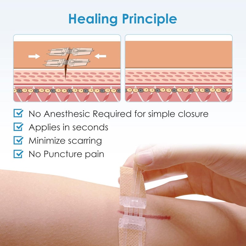 SEABIRD Zip Stitch Wound Closure Kit Butterfly BandagesQuick Clot for Easy Use Surgical QualityEmergency Laceration Closures Strips SutureFree Surgical Repairment First Aid Wound Care Yellow 4 - Image 3