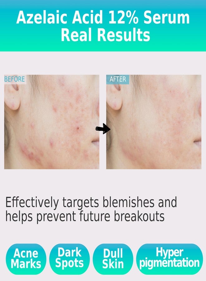 CELDYQUE Azelaic Topical Acid 12% Serum for Face - Dark Spot Remover with Tranexamic Acid, Salicylic Acid, Niacinamide & Centella Asiatica - Acne, Hyperpigmentation & Rosacea Treatment 1 Oz Korean Skincare - Image 3