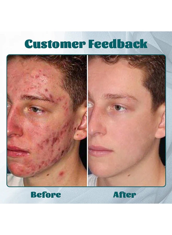 East Moon Adult Men's Acnefree Hydra Cream, Eliminate Dlackheads and Acne, Adult Men's Acnefree Hydra Cream for Fade Facial Fine Lines and Acne Marks, Moisturizing Anti Wrinkle Face Cream That Controls the Balance of Water and Oil 50g - Image 4