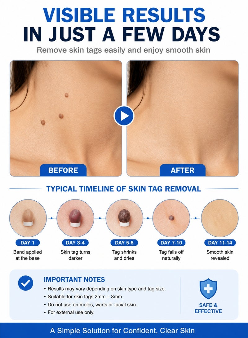 Majestic Skin Tag Removal Kit – Painless Skin Tag Remover Bands Tool for Neck & Body – Easy At Home Skin Tag Removal Device (2–8mm) - Image 4