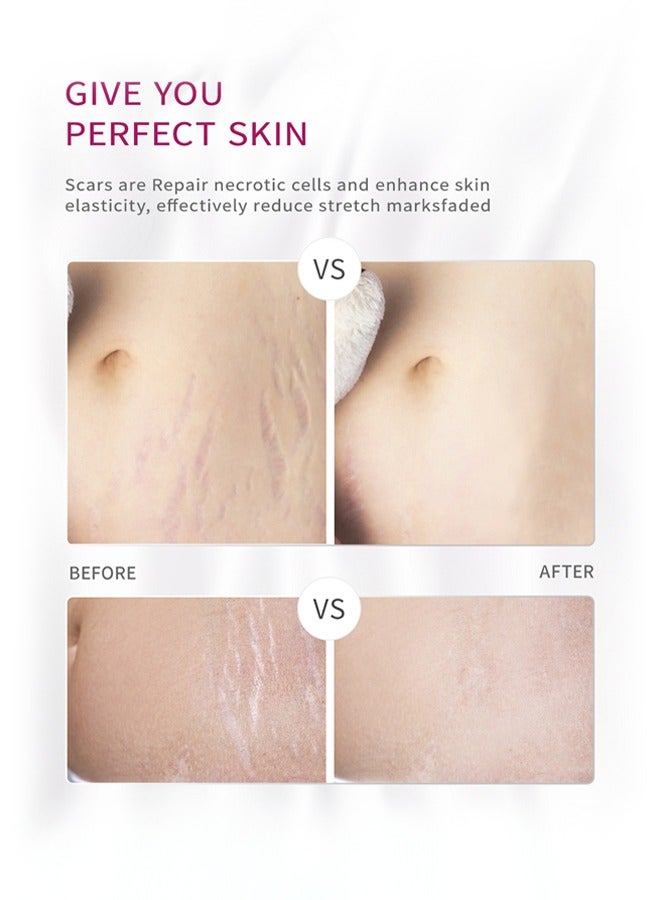 آر توب آر كريم ندوب الحمل المانجو لإصلاح علامات التمدد للأمومة يعزز مرونة الجلد ، ويمكن أن يعزز تجديد الخلايا ، ويصلح الخلايا الميتة ، المصممة لعلامات تمدد الأم - Image 2
