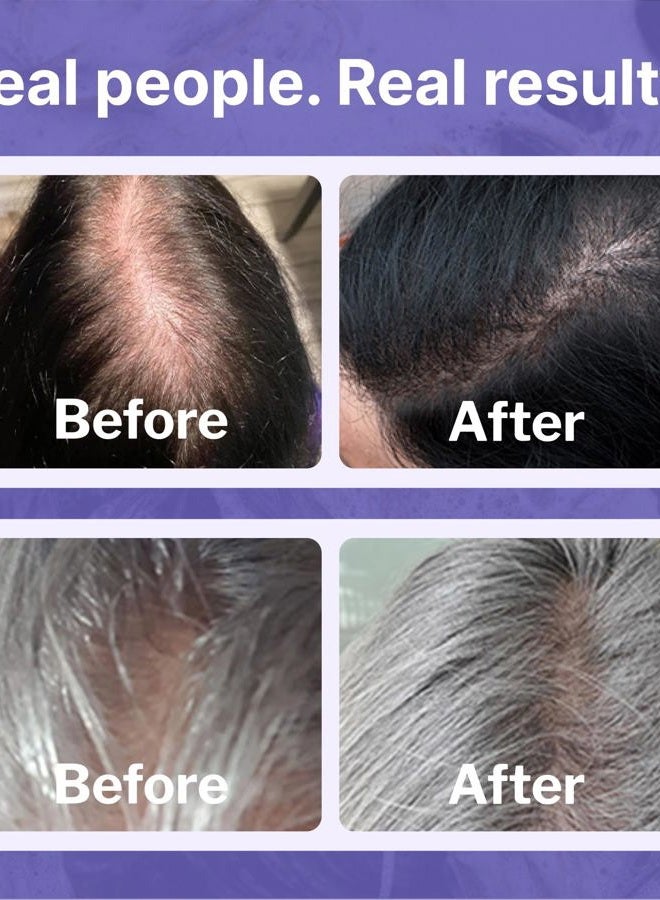 Shapiro MD مجموعة شابيرو إم دي لزيادة نمو الشعر للنساء: شامبو، بلسم، 2% مينوكسيديل، رغوة تترك على الشعر. حل لمشكلة تساقط الشعر وترققه للنساء، 1 شهر - Image 4