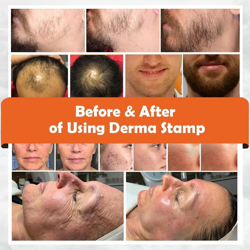DESHCO 140 Titanium Adjustable Microneedling Derma Stamp Derma Microneedle Stamp for Face Hair Beard Scalp Derma Roller Alternative Skin Care Dermastamp For Body Home UseHair Beard Growth - Image 4