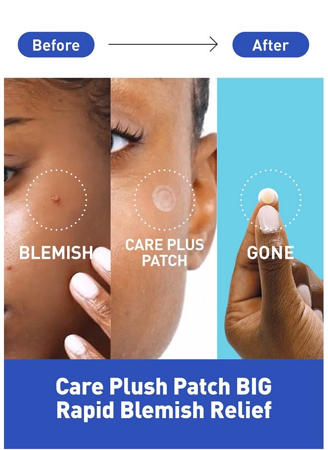 OLIVE YOUNG - Oliveyoung Careplus Big Size Acne Spot Patches 81Count (12Mm45Ea+14Mm36Ea)Extra Coverage Zit Absorbing Cover Patch Moist Wound Dressing For Skin Trouble Korean Invisible Pimple Hydrocolloid Stickers - Image 1