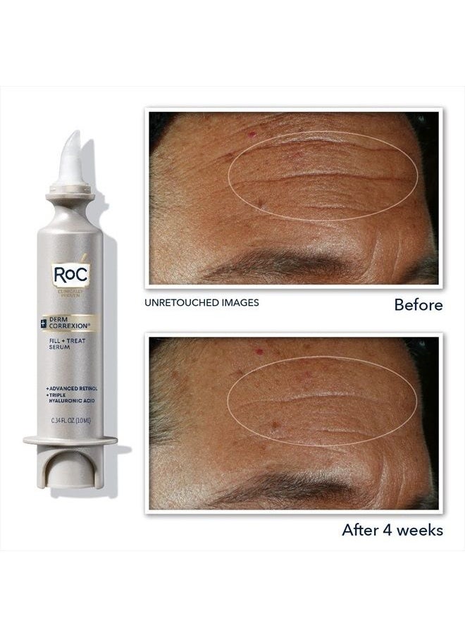 RoC - Derm Correxion Fill + Treat Advanced Retinol Serum, Wrinkle Filler Treatment with Hyaluronic Acid for Forehead Wrinkles, Crow's Feet, Eleven Wrinkles, and Laugh Lines, 15ml - Image 1