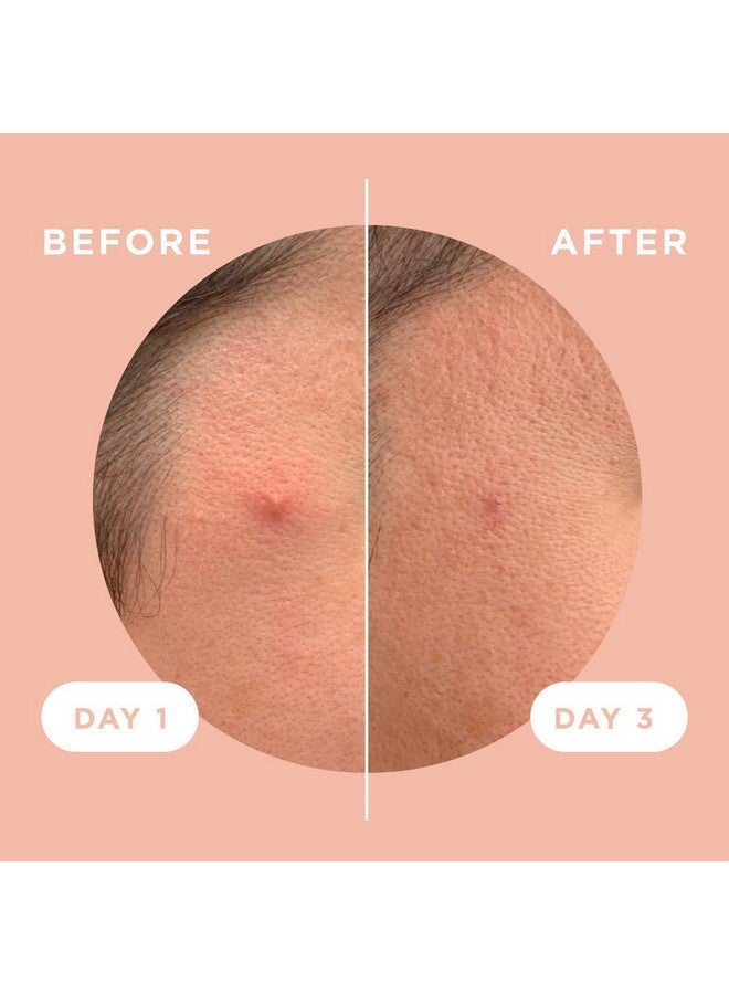 ZitSticka Killa Pimple Patches for Face - World's Most Potent Pimple Patch with Fast-Acting Microdarts - Starts Working within 2 Hours for Deep, Early-Stage Zits - 8 Count - Image 5