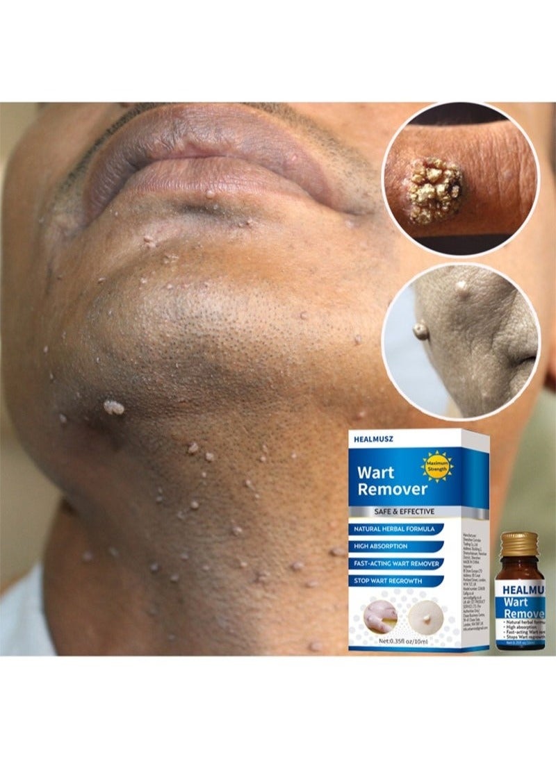 HEALMUSZ حل إزالة الثآليل والذرة بتركيبة حصرية، حل سائل لإزالة الثآليل، حل سريع المفعول لإزالة الذرة للثآليل الأخمصية، الذرة، الثآليل الشائعة والثآليل المسطحة - Image 4