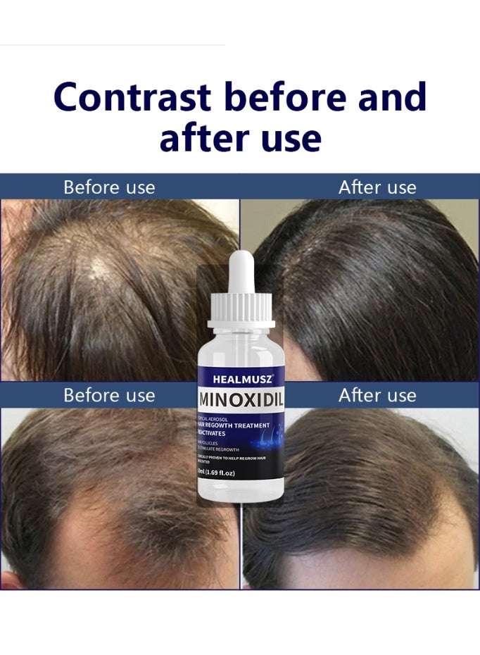 HEALMUSZ HEALMUSZ Minoxidil Hair Growth Spray – Stimulates hair follicles, volumizes and strengthens hair, nourishes hair roots, prevents hair loss, fragrance-free 50ml*2 - Image 4