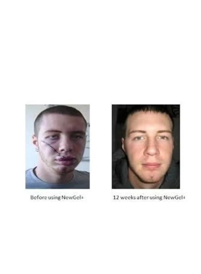 نيو جل جل سيليكون متطور لعلاج الندب وأثار الجرح 15جرام - Image 3