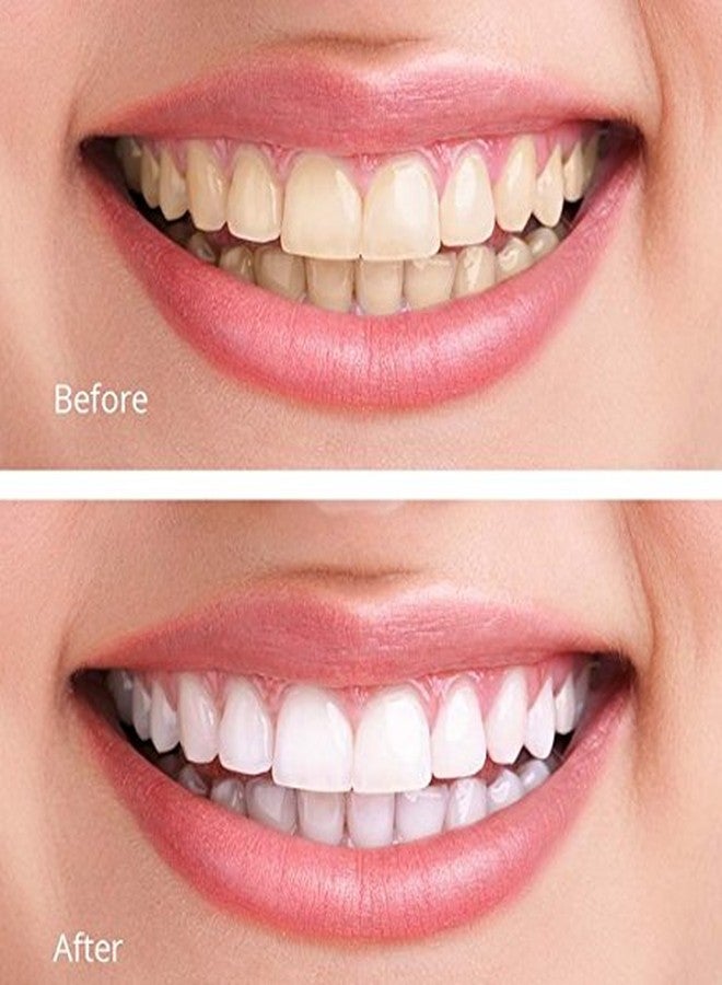 White Teeth Global تبييض الأسنان العالمي (TM) 44% بيروكسيد الكارباميد 10 (10 مل) حقن جل تبييض الأسنان - (2) صواني - (1) دليل درجات اللون - (1) ورقة تعليمات - تبييض الأسنان في المنزل! - Image 4