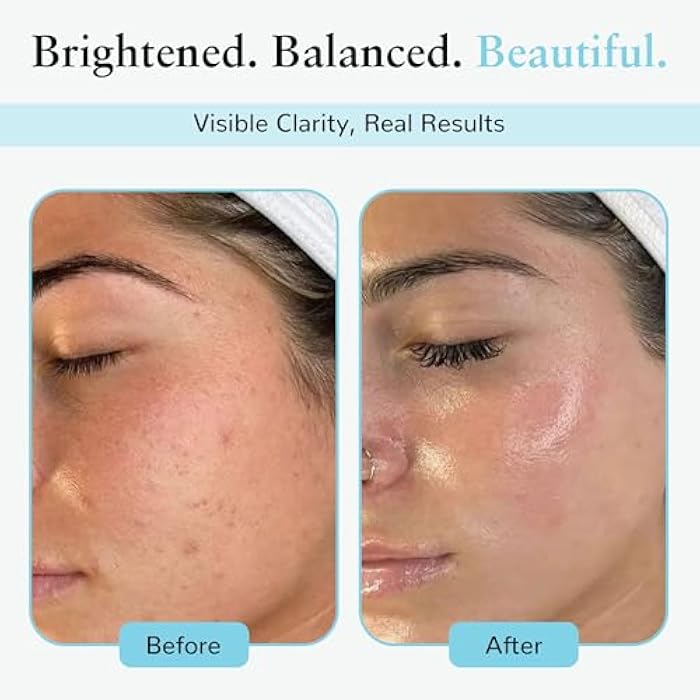 PERFECT IMAGE Lactic 50% Gel Peel, Chemical Peels for Face Breakout Scars, Chemical Exfoliant for Face, Strength Level 2, 1.0 fl oz. e, 30 mL – Perfect Image - Image 4