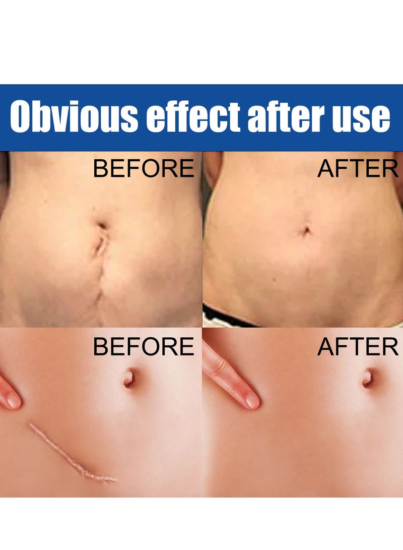 EELHOE New Gel Advanced Silicone Gel Of Scar Cream - Image 2
