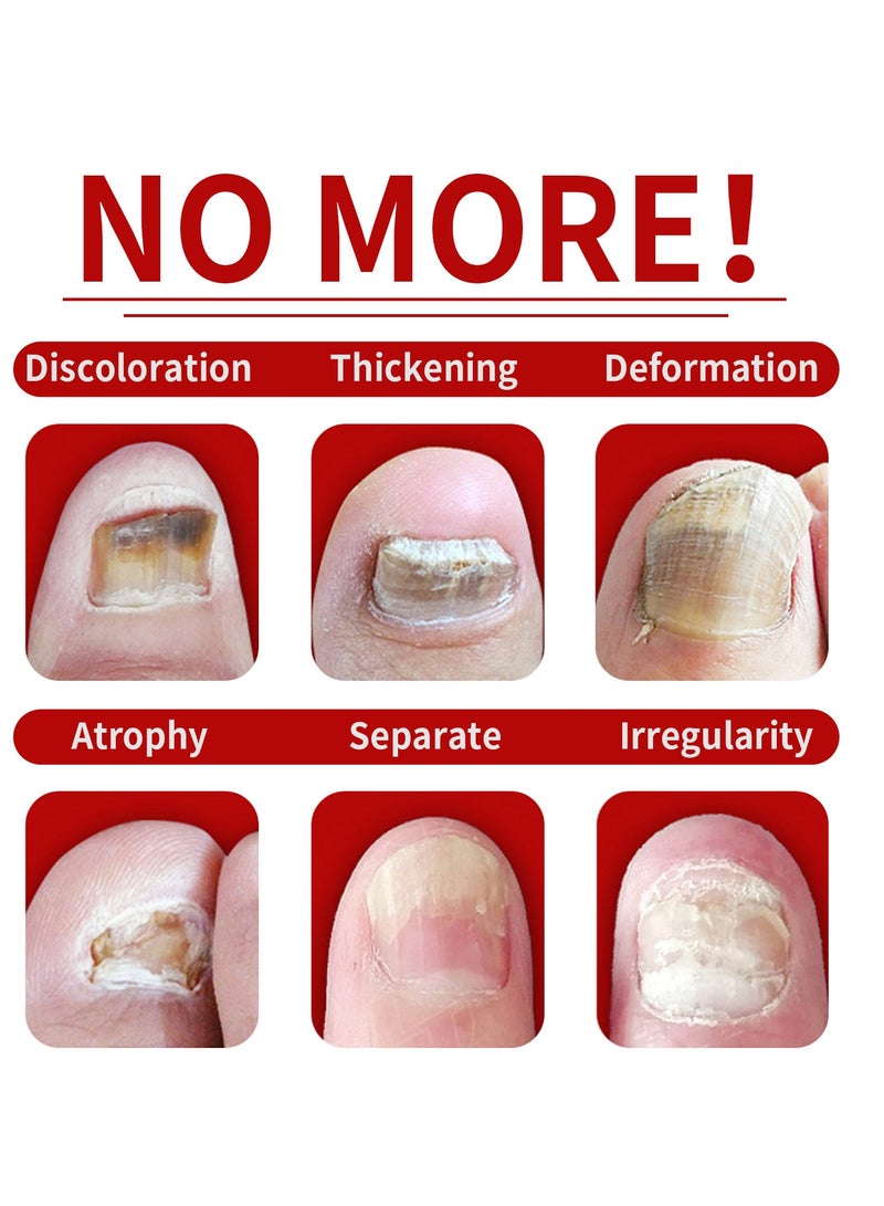 Jaysuing Nail Fungus Treatment for Nail Care Onychomycosis Repair and Moisturizing - Image 5