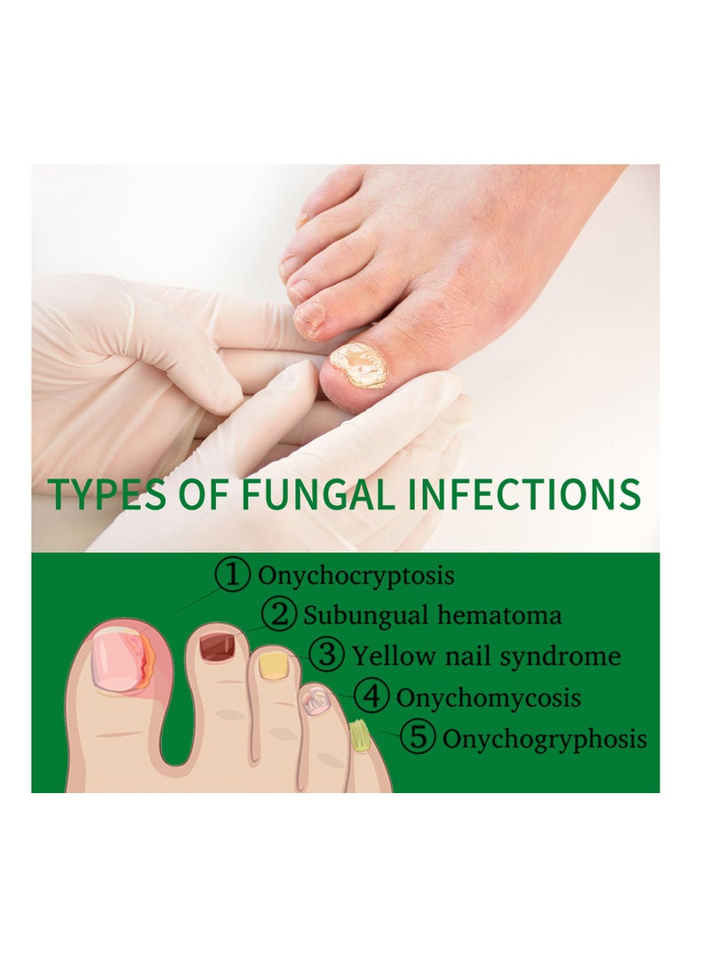 Jaysuing Nail Fungus Treatment for Nail Care Onychomycosis Repair and Moisturizing - Image 3