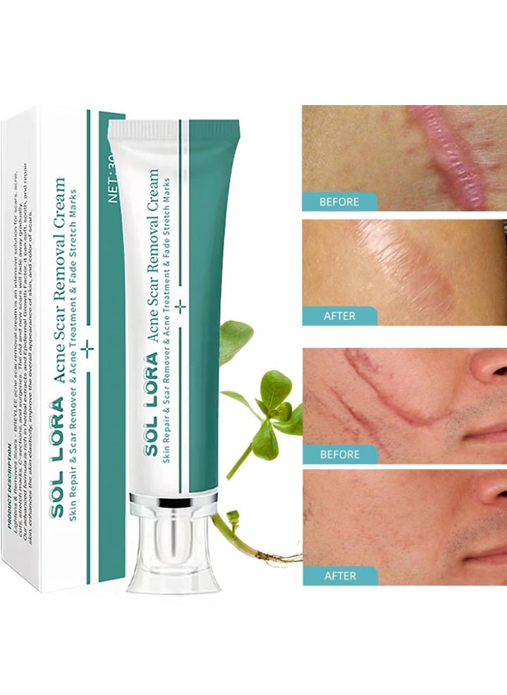 SOL LORA Acne Scar Removal Cream，Skin Repair Scar Remover & Acne Treatment & Fade Stretch Marks, Scar Erase ,Scar Removal Gel,Acne Scar Treatment,Deep Acne Scar Removal,Burns Keloids Hypertrophic,Repair Damaged Skin 30g  - Image 1