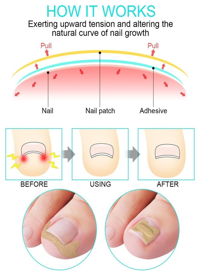 Orbica Toenail Tool | Nail Treatment Corrector Sticker | Treatment Correction Pedicure White | Strong Adhesion Toenail Corrector Strips | Breathable Elastic for Correction (5 pcs) - Image 3