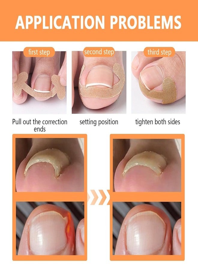 Orbica Toenail Tool | Nail Treatment Corrector Sticker | Treatment Correction Pedicure White | Strong Adhesion Toenail Corrector Strips | Breathable Elastic for Correction (5 pcs) - Image 5