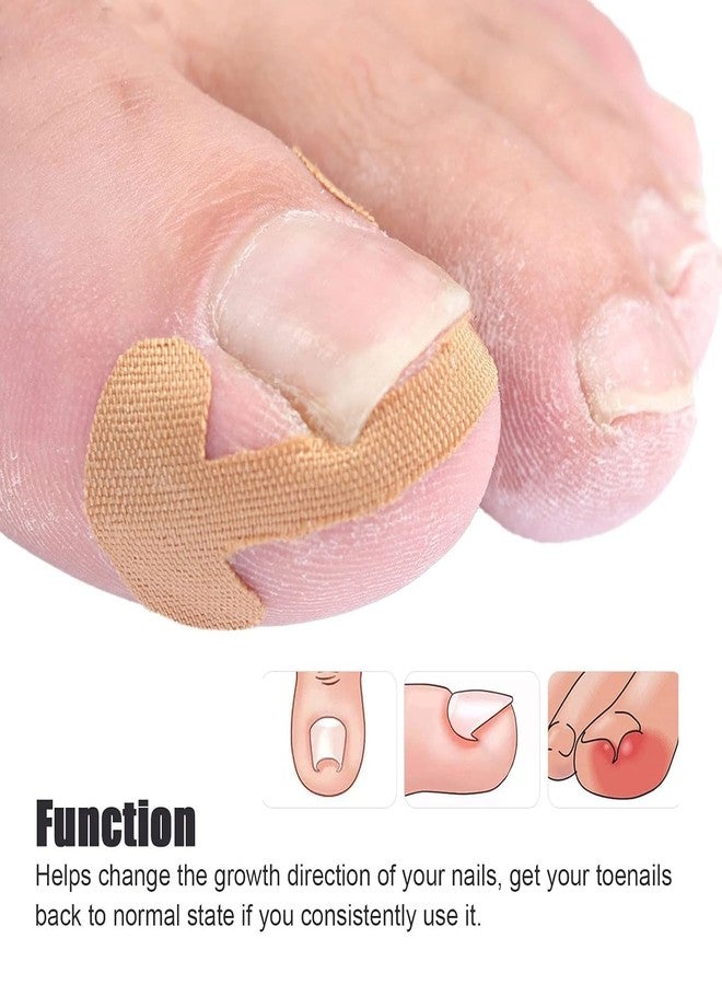 Orbica Toenail Tool | Nail Treatment Corrector Sticker | Treatment Correction Pedicure White | Strong Adhesion Toenail Corrector Strips | Breathable Elastic for Correction (5 pcs) - Image 2