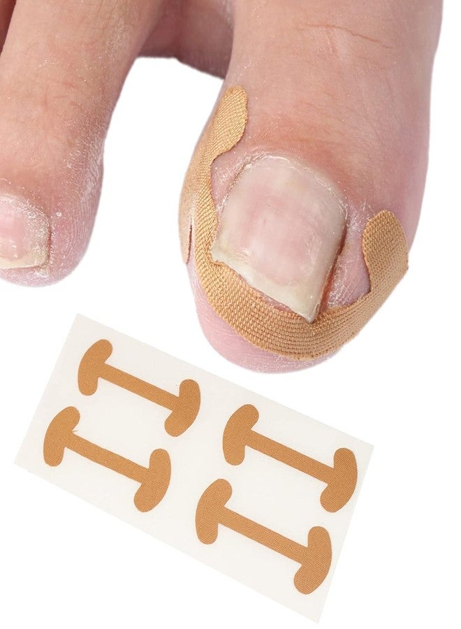 Orbica Toenail Tool | Nail Treatment Corrector Sticker | Treatment Correction Pedicure White | Strong Adhesion Toenail Corrector Strips | Breathable Elastic for Correction (5 pcs) - Image 1