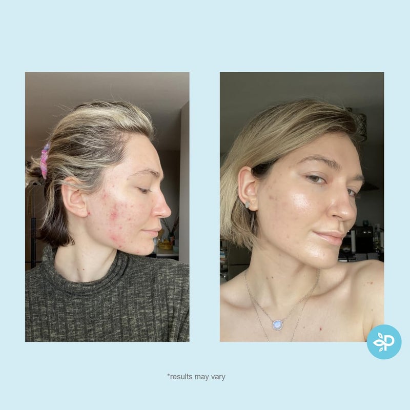 PERFECT IMAGE Hydro-Glo Peel Pads - Enhanced with Kojic, Mandelic, Glutathione, Licorice, Papaya, Pineapple, Bearberry Extracts (10% Strength Peel) - Image 2