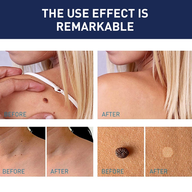 EELHOE 144PCS Skin Tag Patches Fast Healing Mole Wart Remover Waterproof Non-drying for All Skin Type - Image 5