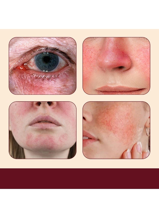 Rosacea Care كريم علاج الوردية للوجه تخفيف احمرار الأنف احمرار حب الشباب 30غ - Image 2