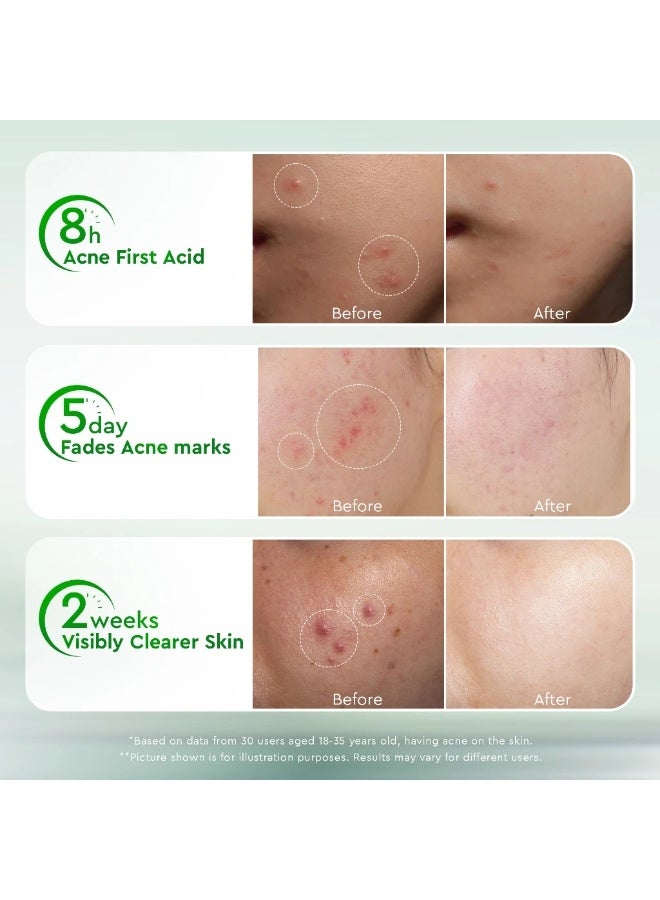 Glad2Glow Acne Drying Lotion Calms Acne Treatment Salicylic Acid Pimple Acne Patch Scar Dark Spot Package of 2 - Image 4