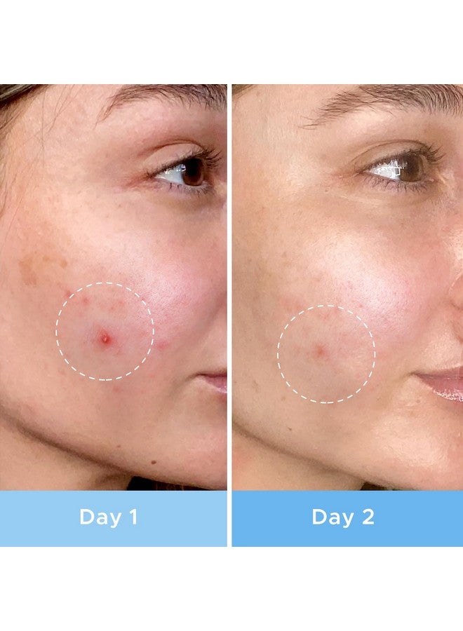 LitBear LitBear Pimple Patches, Upgraded Invisible Acne Cover Patch, Hydrocolloid Acne Patches for Face with Salicylic Acid, Zits Patches for Acne, Bleimish, Pimple Stickers Acne Dots  - Image 5